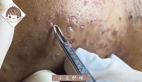 挤痘痘和挤黑头的视频,视频教学与注意事项